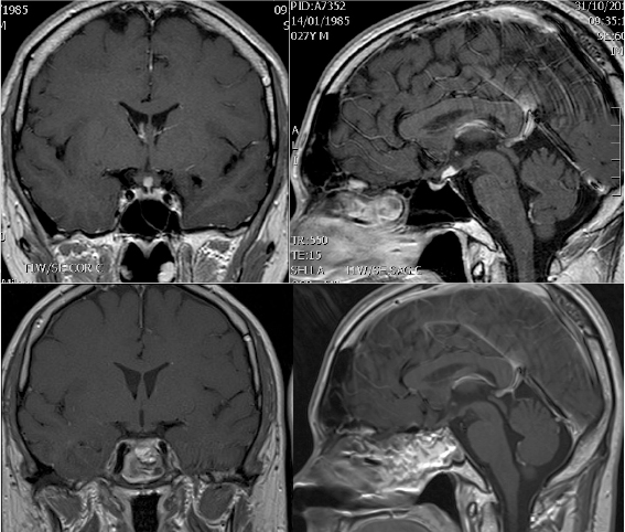 xantogranuloma