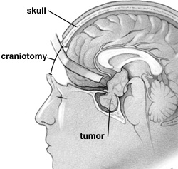 Trancranial